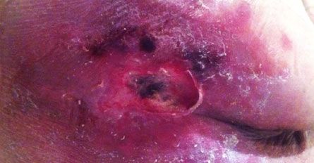 Ulcera PolyMem