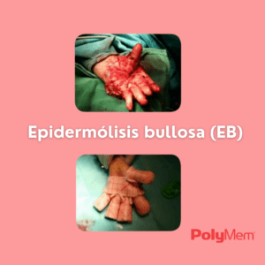 epidermolisis-bullosa